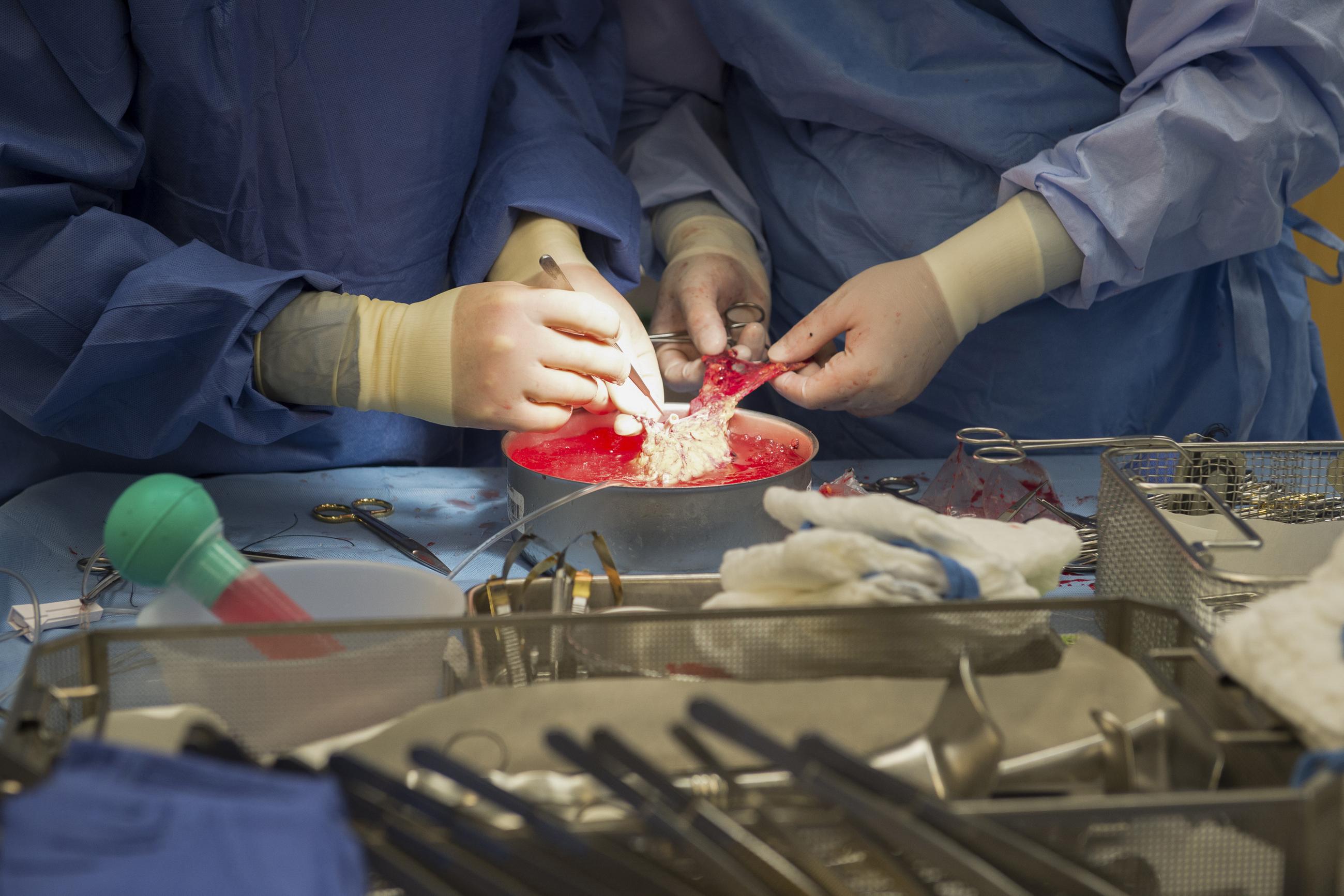 Surgeons work on a kidney during a transplant surgical procedure. (AP Photo/Molly Riley, File)